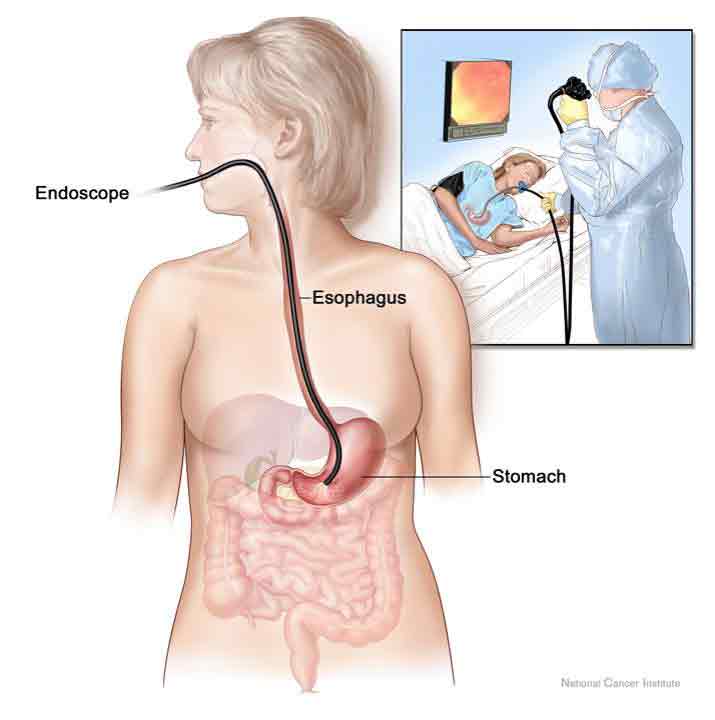 diagram-endoscopy-egd.jpg (20 KB)